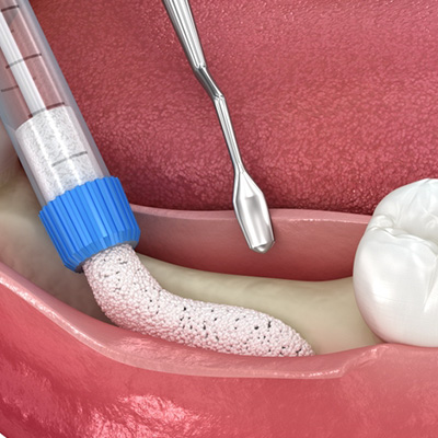 BoneGraft