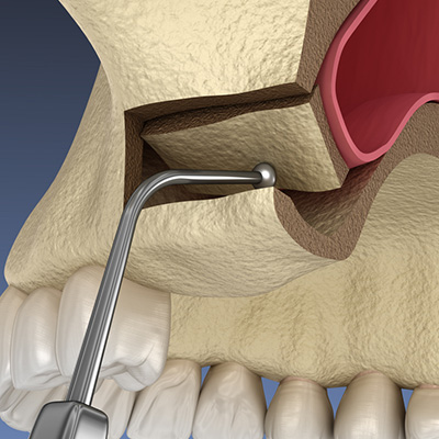 Sinus Lift