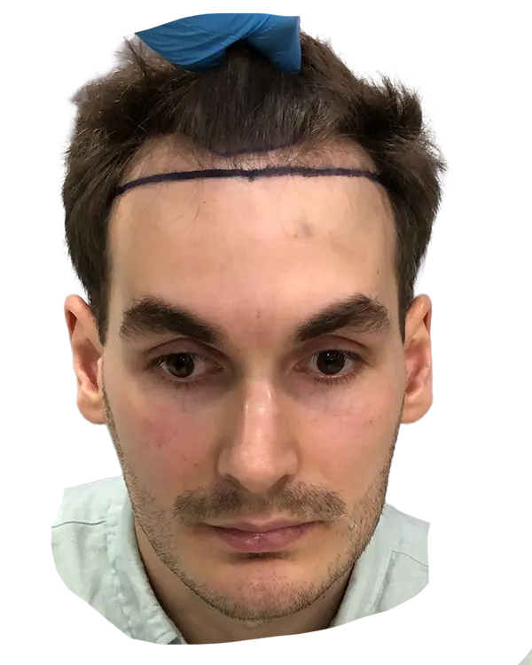 Oskar Before