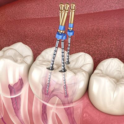 RootCanal1TreatmentMultiple