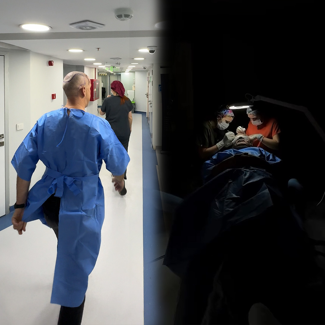 Zabieg transplantacji włosów