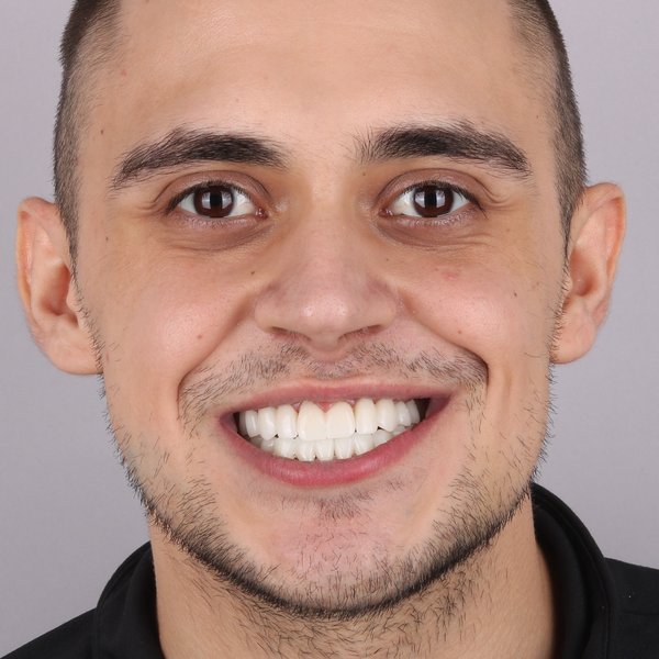 Bartosz Po Zabiegu