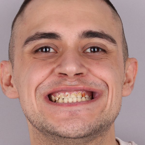 Bartosz Przed Zabiegiem
