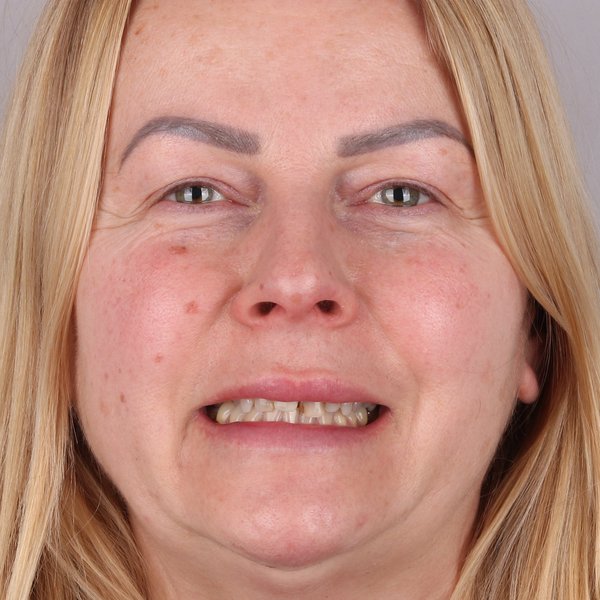 Karina Przed Zabiegiem