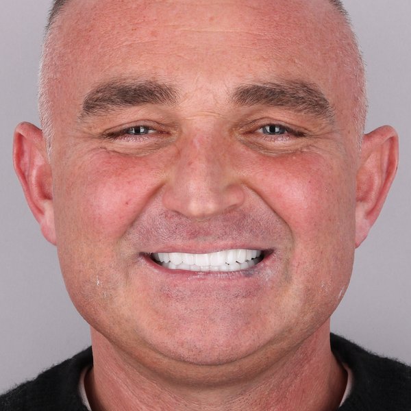 Tomasz Po Zabiegu