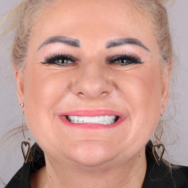 Małgorzata Po Zabiegu