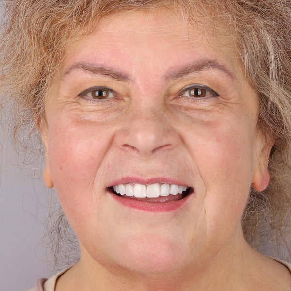 Iwona Po Zabiegu