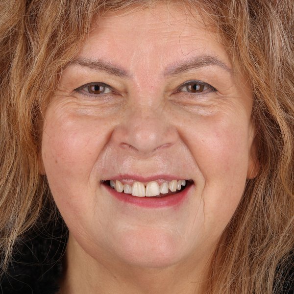 Iwona Przed Zabiegiem