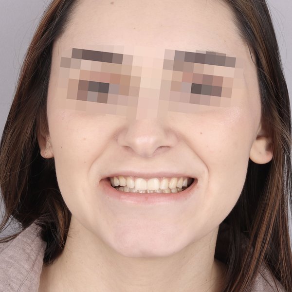 Wiktoria Przed Zabiegiem