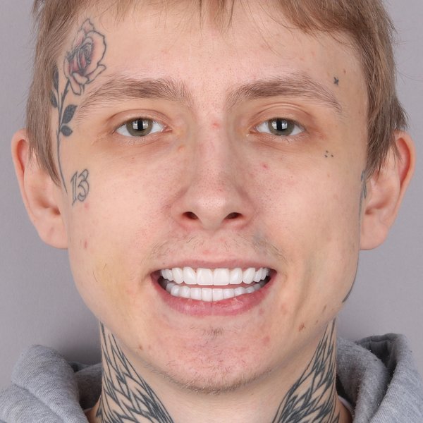Kamil Po Zabiegu