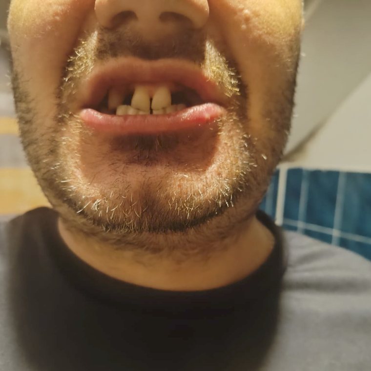 Grzegorz Przed Zabiegiem