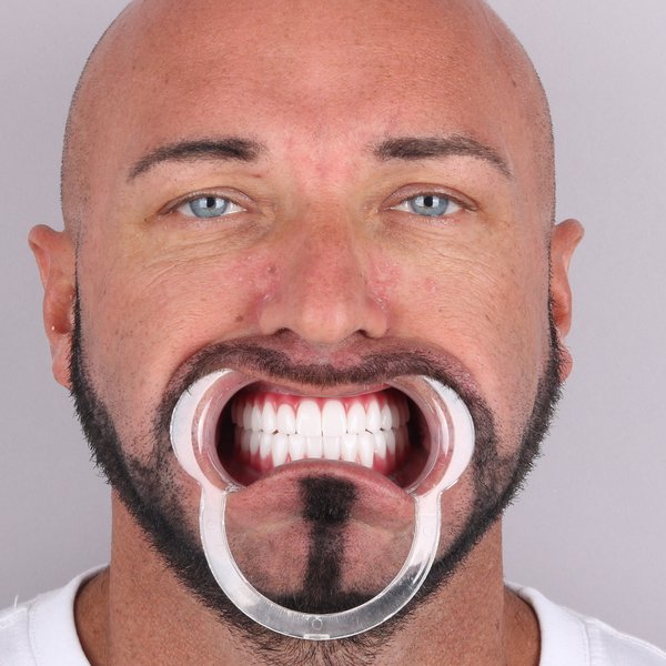 Krzysztof Po Zabiegu