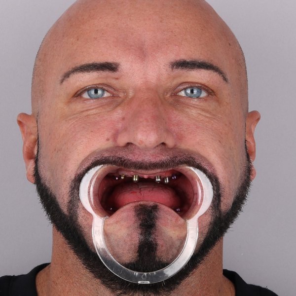 Krzysztof Przed Zabiegiem