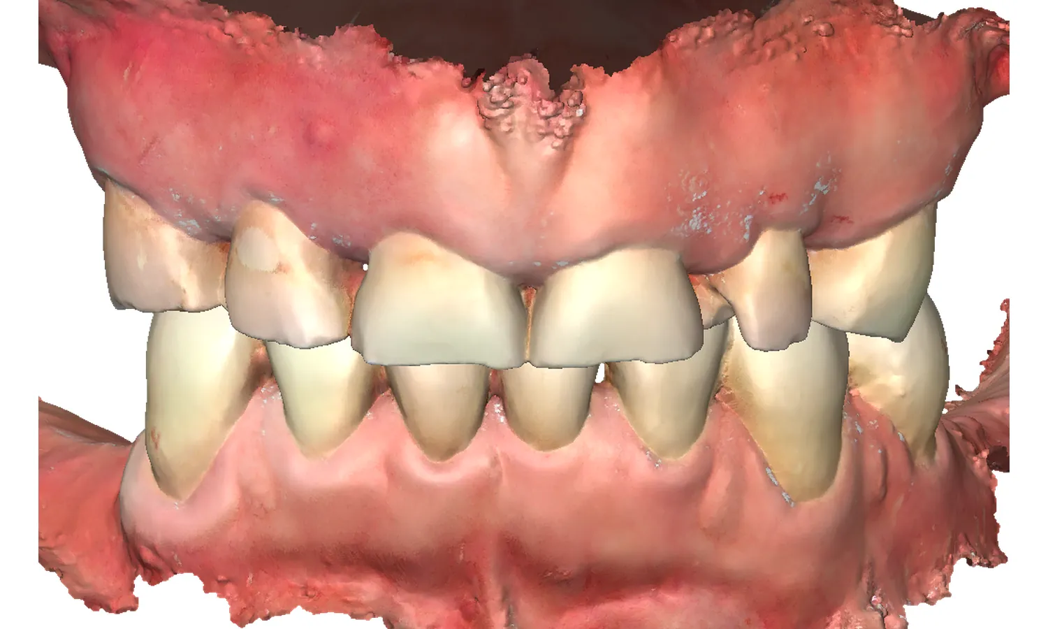 Skan 3D zgryzu przed leczeniem