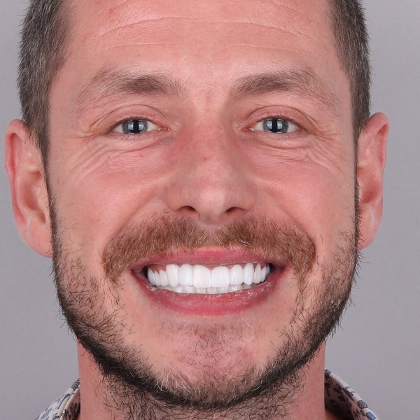 Damian Po Zabiegu