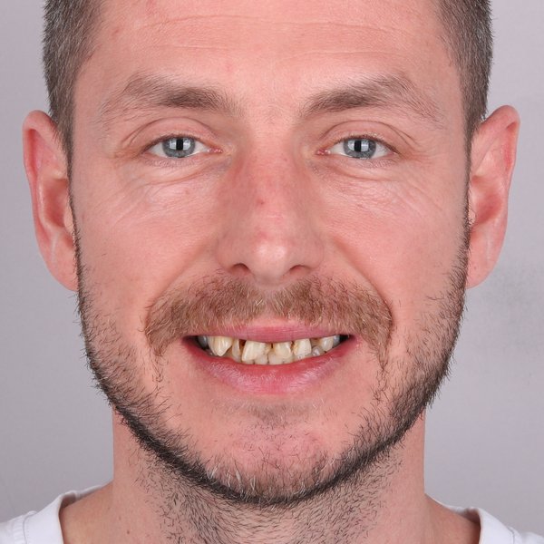 Damian Przed Zabiegiem