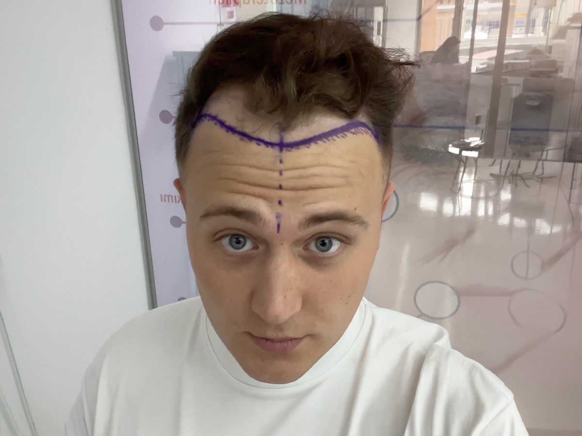 Pasofix — przed zabiegiem