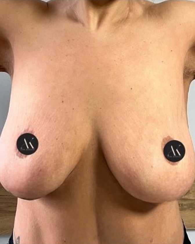 Piersi PRZED #7