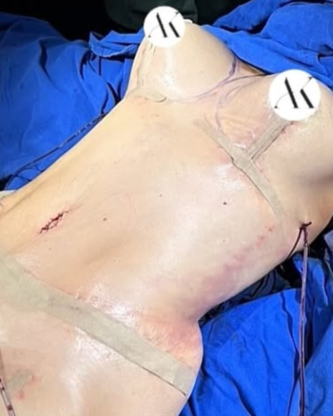 Liposukcja PO #2