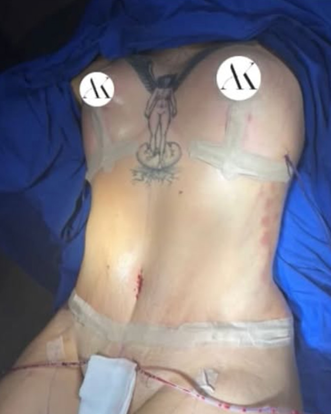 Liposukcja PO #4