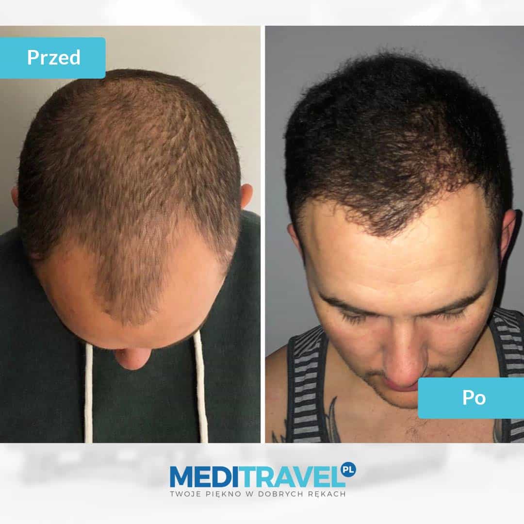 przeszczep włosów - przed i po