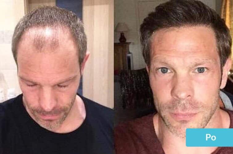 przeszczep włosów - przed i po