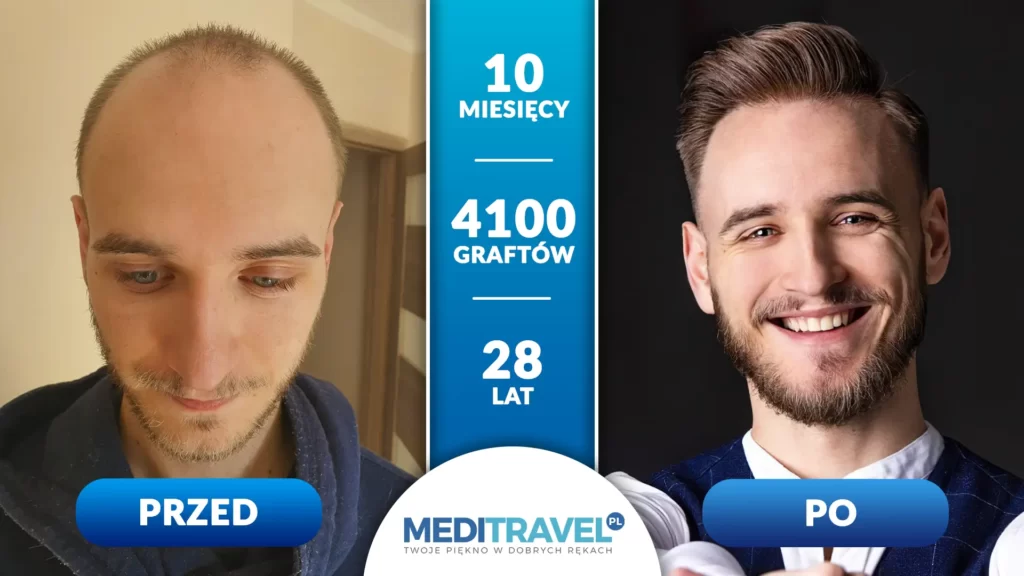 Przeszczep włosów przed i po, 4100 graftów