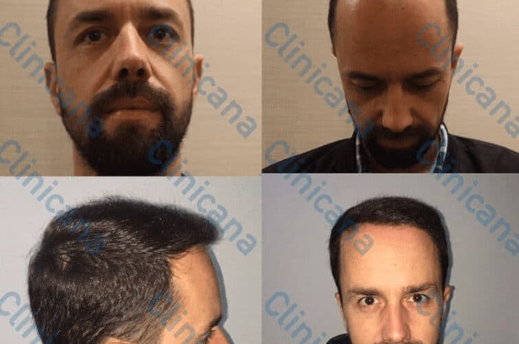 Przeszczep włosów - Przed i po
