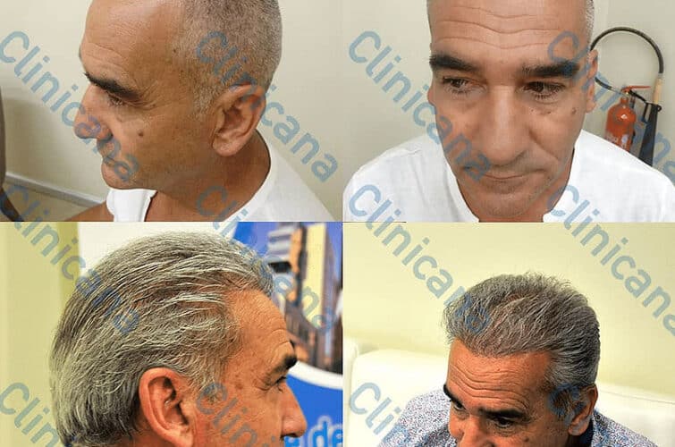 Przeszczep włosów - Przed i po