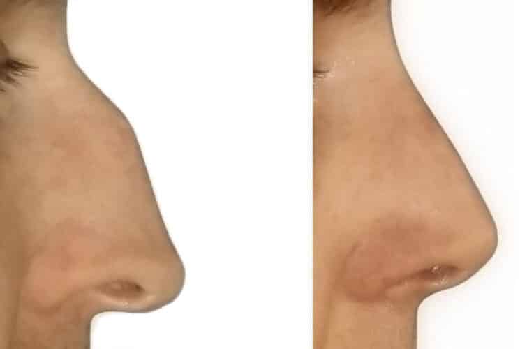 operacja nosa - przed i po