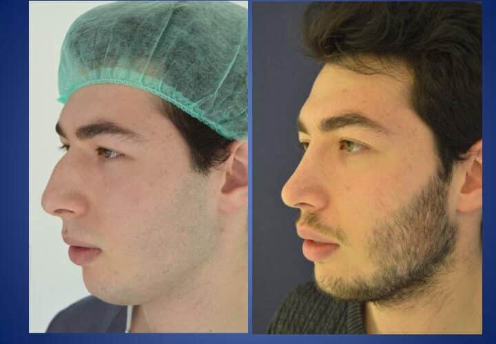 operacja nosa - rynoplastyka