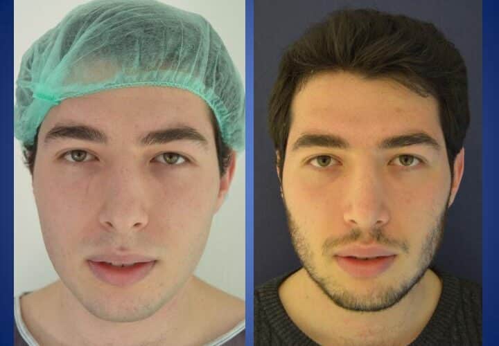 operacja nosa - rynoplastyka