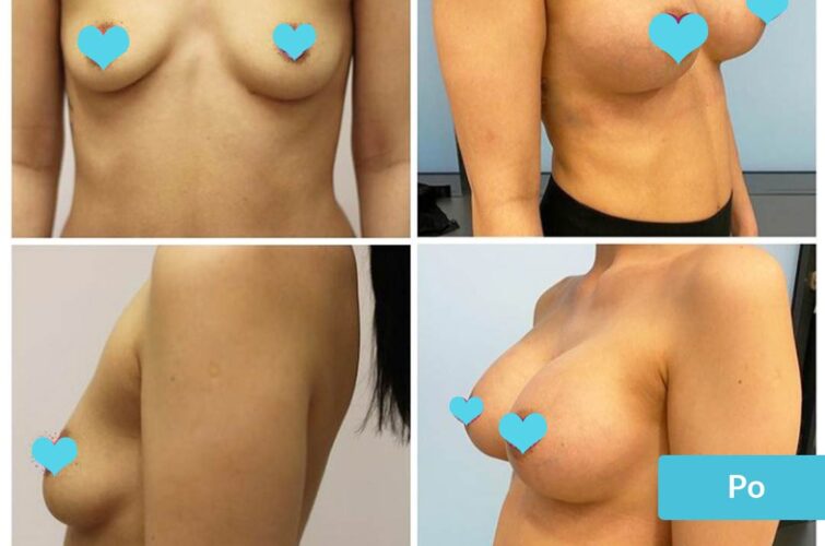 Operacja powiększanie piersi