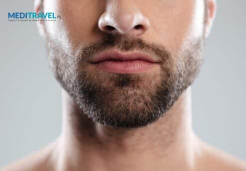 5 faktów, które powinieneś wiedzieć rozważając przeszczep włosów brody