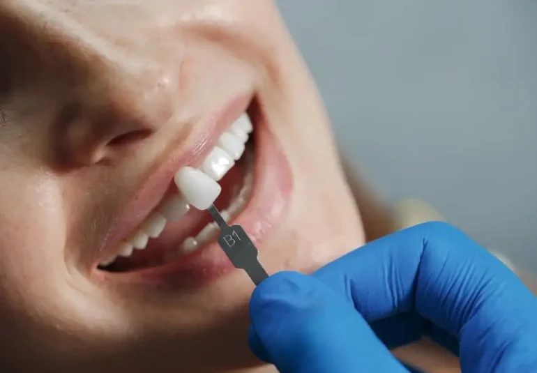 moda-na-hollywood-smile-czy-warto