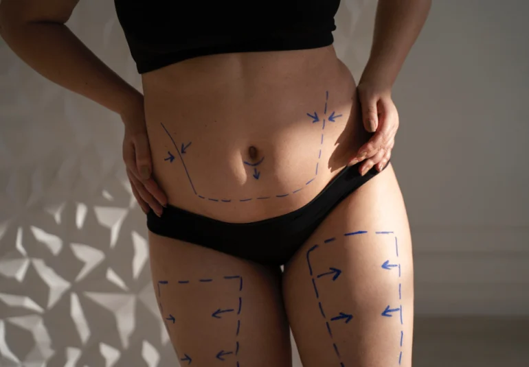 abdominoplastyka-dla-kobiet-po-ciazy-odzyskaj-swoje-cialo-po-macierzynstwie