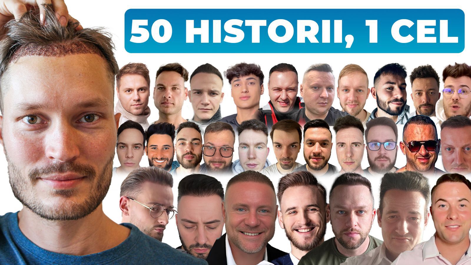50 Polaków po przeszczepie włosów w Turcji – efekt metamorfozy po zabiegu przeszczepu włosów metodą FUE lub DHI