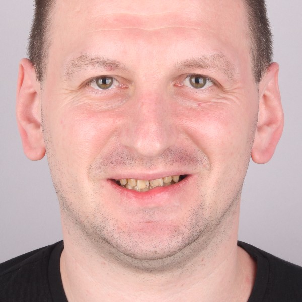 Robert Przed Zabiegiem