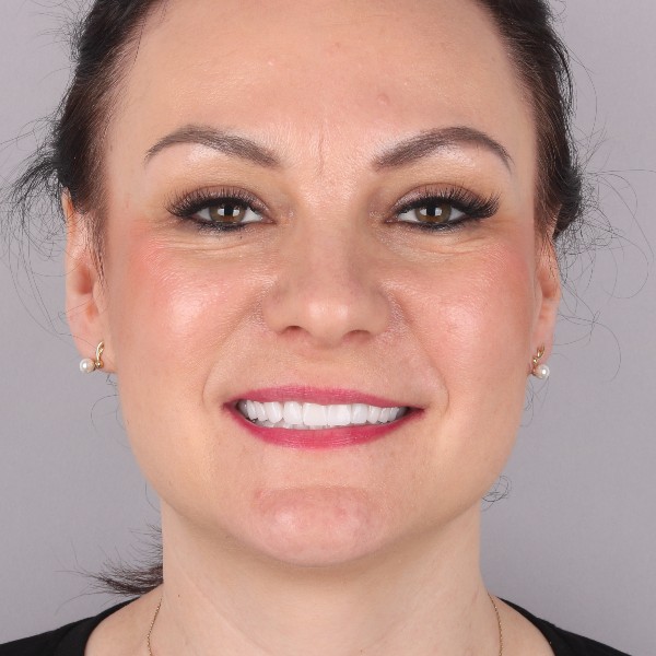 Ewelina Po Zabiegu