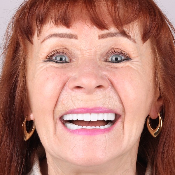 Barbara Po Zabiegu