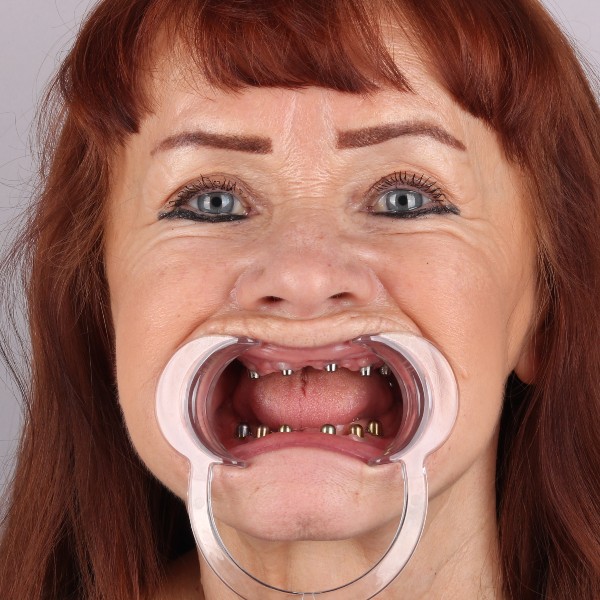 Barbara Przed Zabiegiem