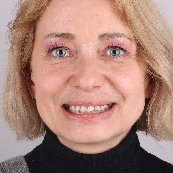 Agnieszka przed leczeniem