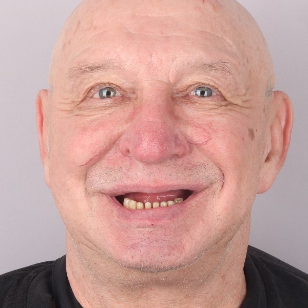 Andrzej Przed Zabiegiem