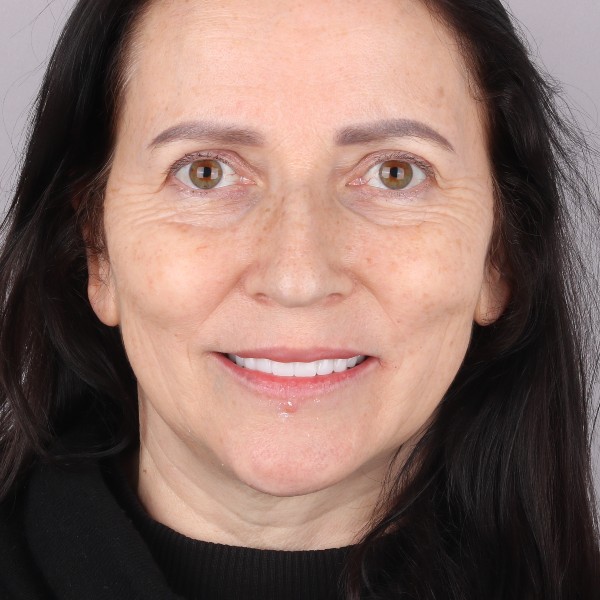 Izabela Po Zabiegu