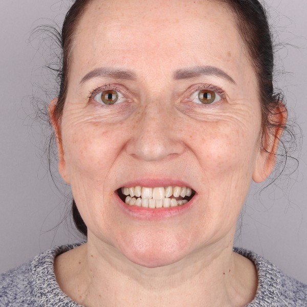 Izabela Przed Zabiegiem
