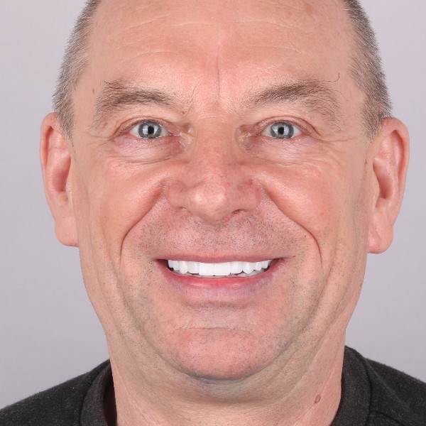 Metamorfoza uśmiechu, Hollywood Smile w Turcji