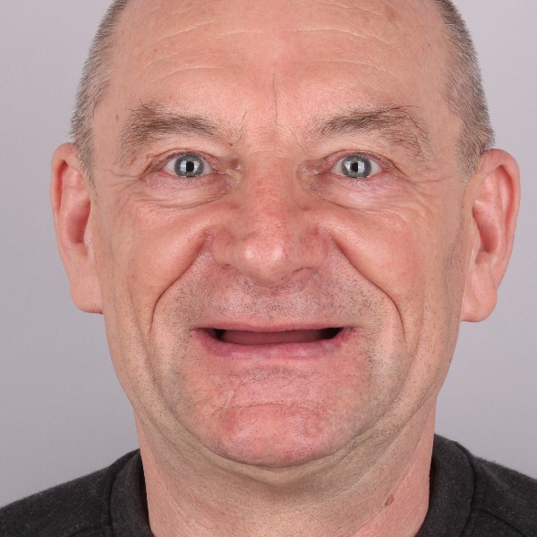 Stanisław Przed Zabiegiem