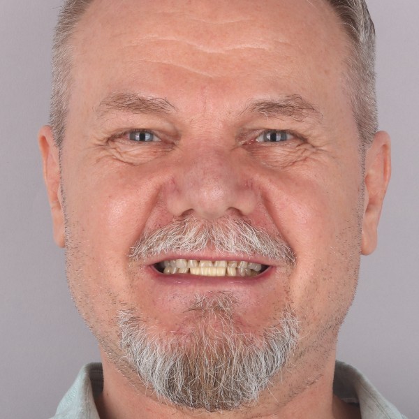 Witold Przed Zabiegiem