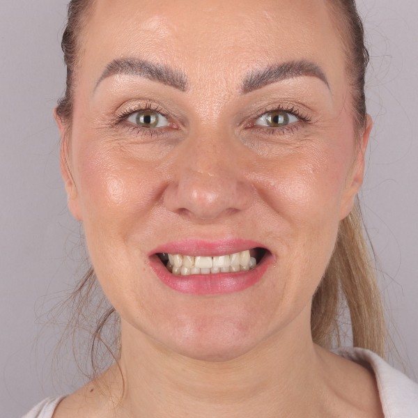 Monika Przed Zabiegiem