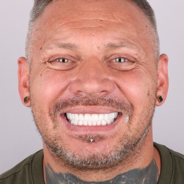 Adrian Po Zabiegu